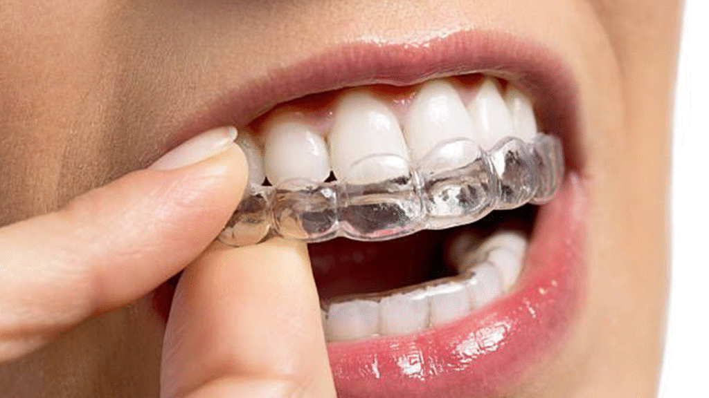 Clear braces