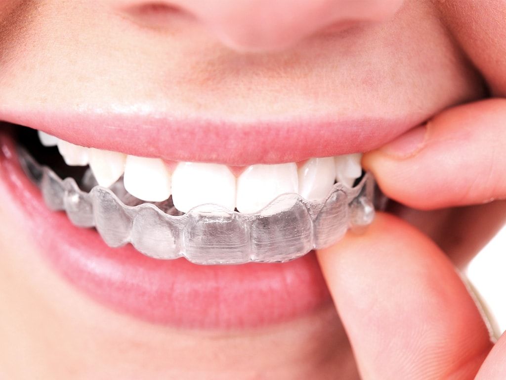 Clear retainers