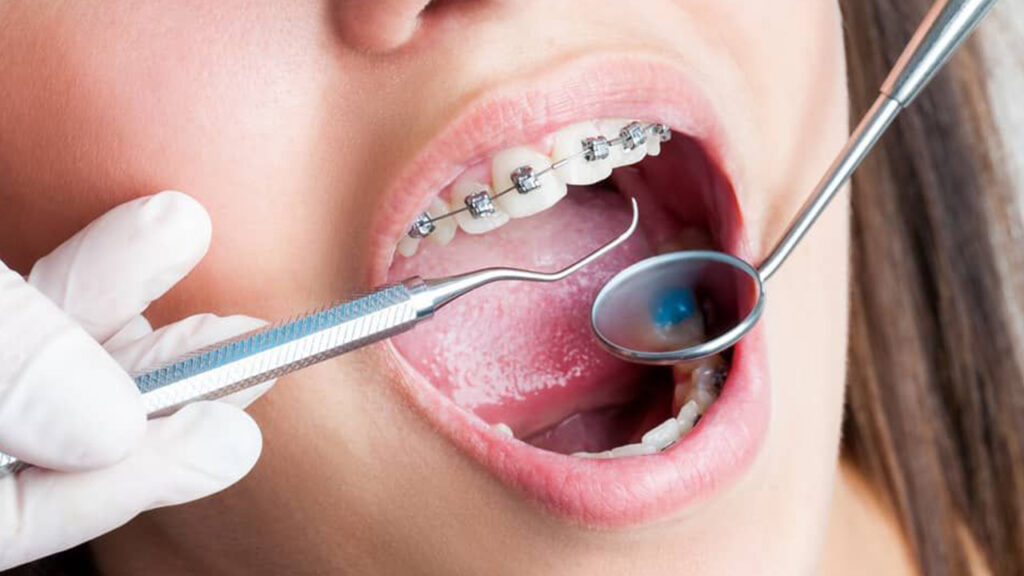 จัดฟันโดยไม่ถอนฟัน