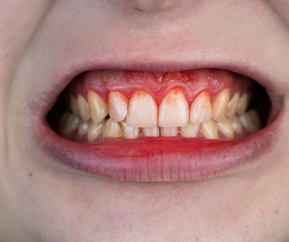 เลือดออกตามไรฟันบ่อย