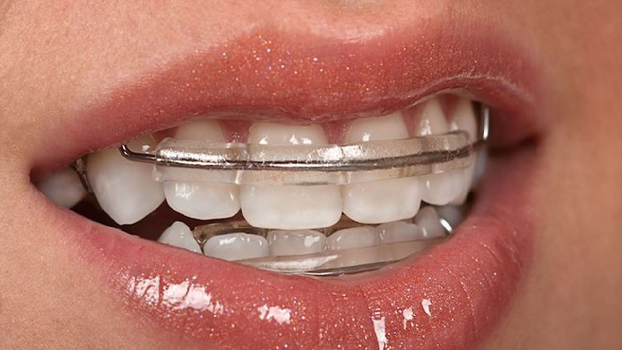 ใส่รีเทนเนอร์นานแค่ไหนหลังจัดฟัน