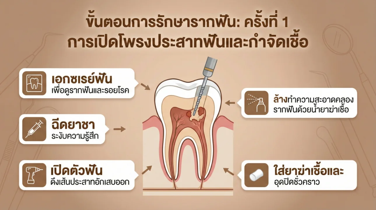 ขั้นตอนการรักษารากฟัน