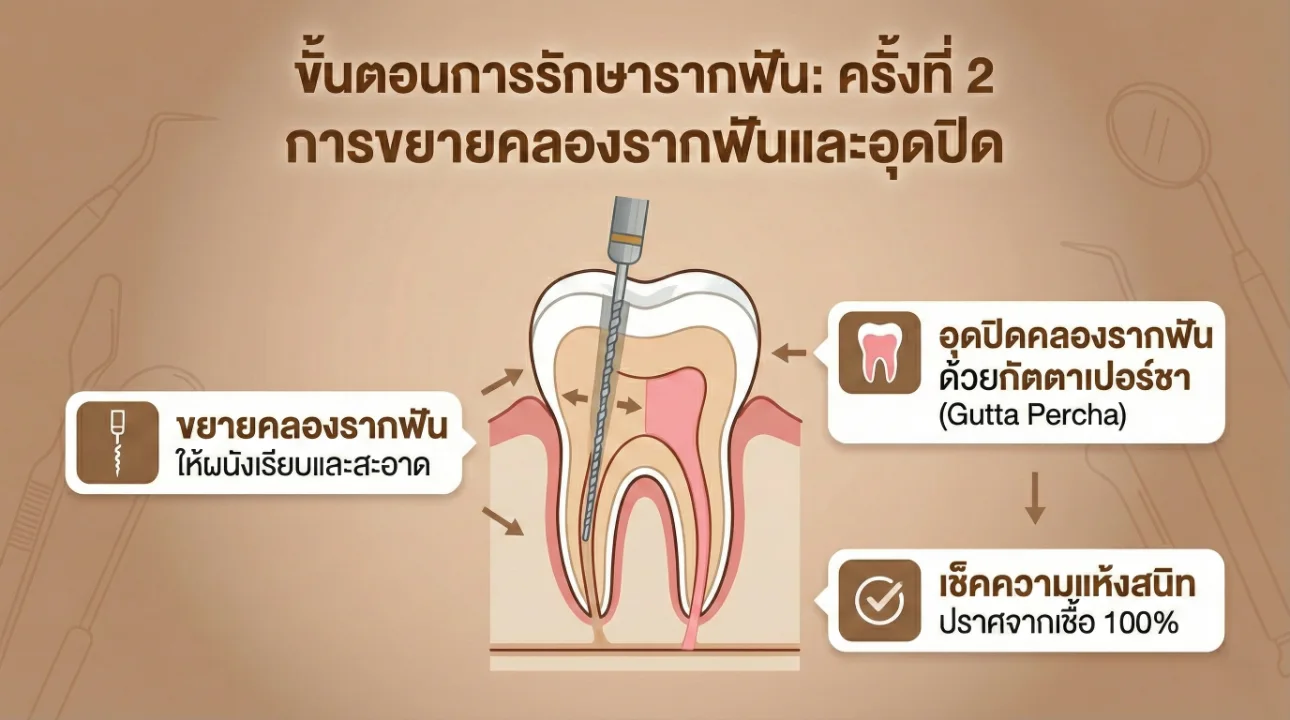 ขั้นตอนการรักษารากฟัน2