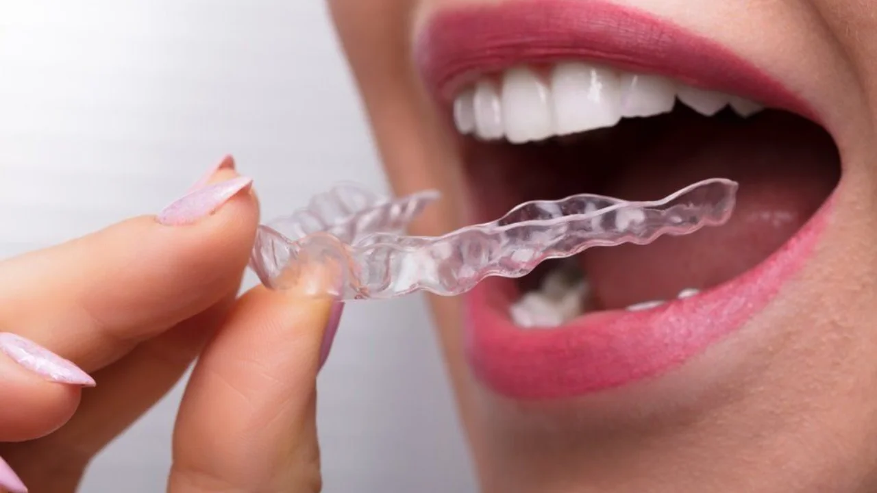 จัดฟันใส invisalign ราคา