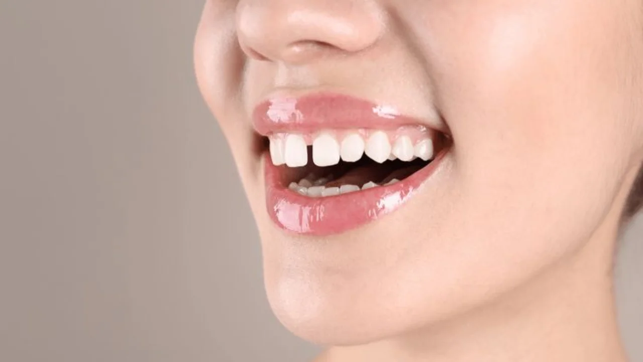 ฟันหน้าห่าง อุดได้ไหม