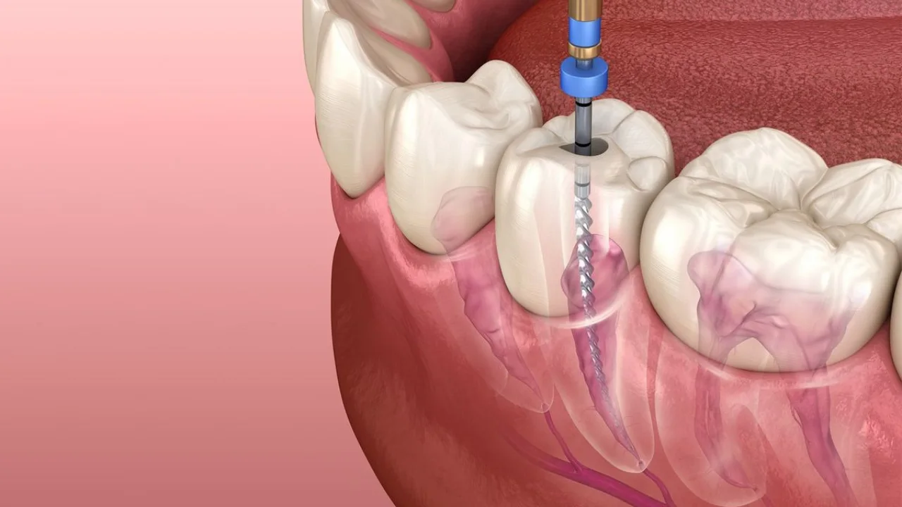 รักษารากฟัน กี่ครั้งเสร็จ