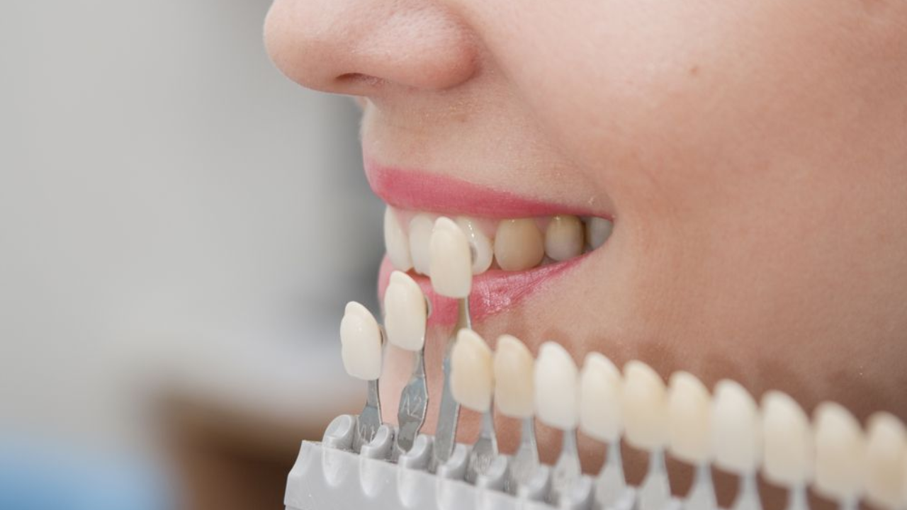 อุดฟันสีเหมือนฟัน