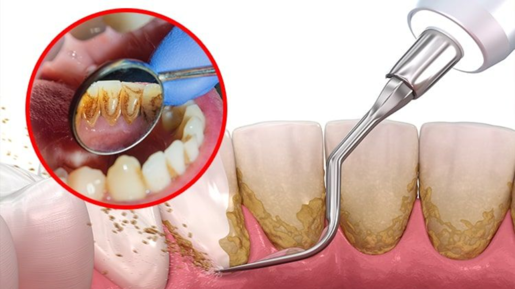 ขูดหินปูนช่วยอะไร ทำไมควรทำทุก 6 เดือน
