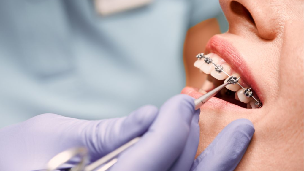 จัดฟันแบบไหนดี แตกต่างกันยังไง เหมาะกับใคร