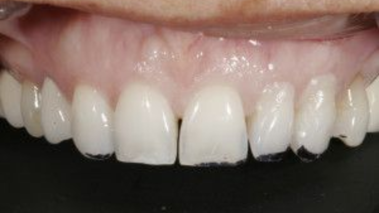 ตัดเหงือกปรับรูปหน้า เปลี่ยนรอยยิ้ม