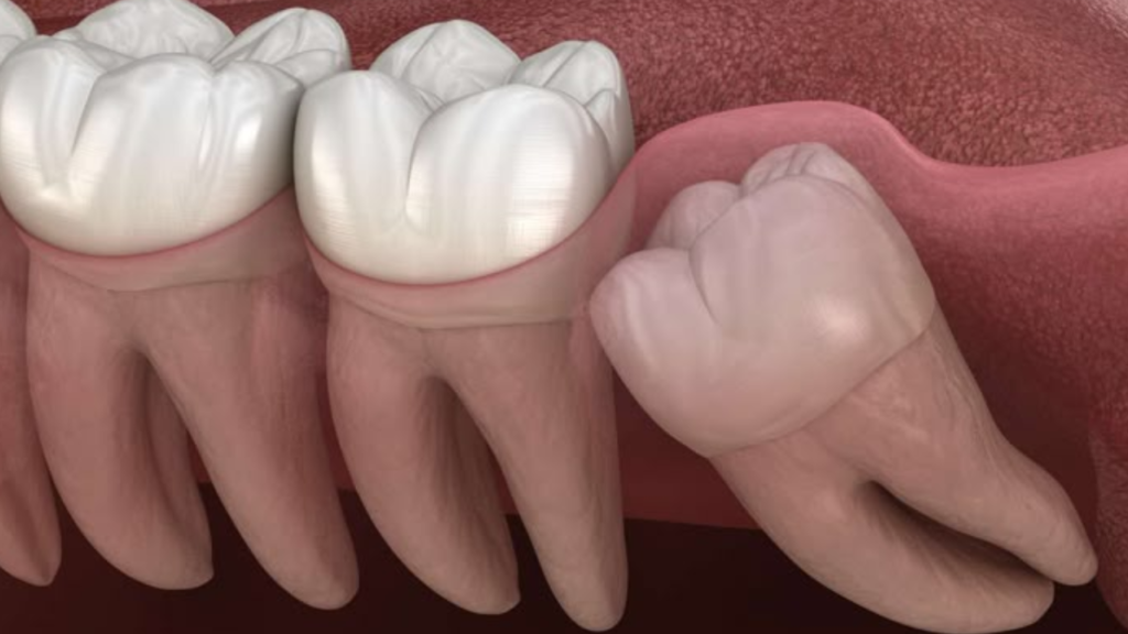 ฟันคุดปวดแบบไหนต้องรีบผ่า