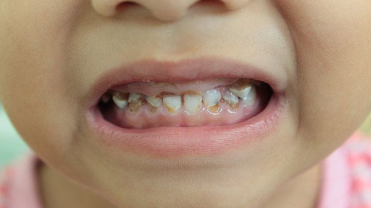 วิธีดูแลฟันน้ำนมลูกไม่ให้ผุ