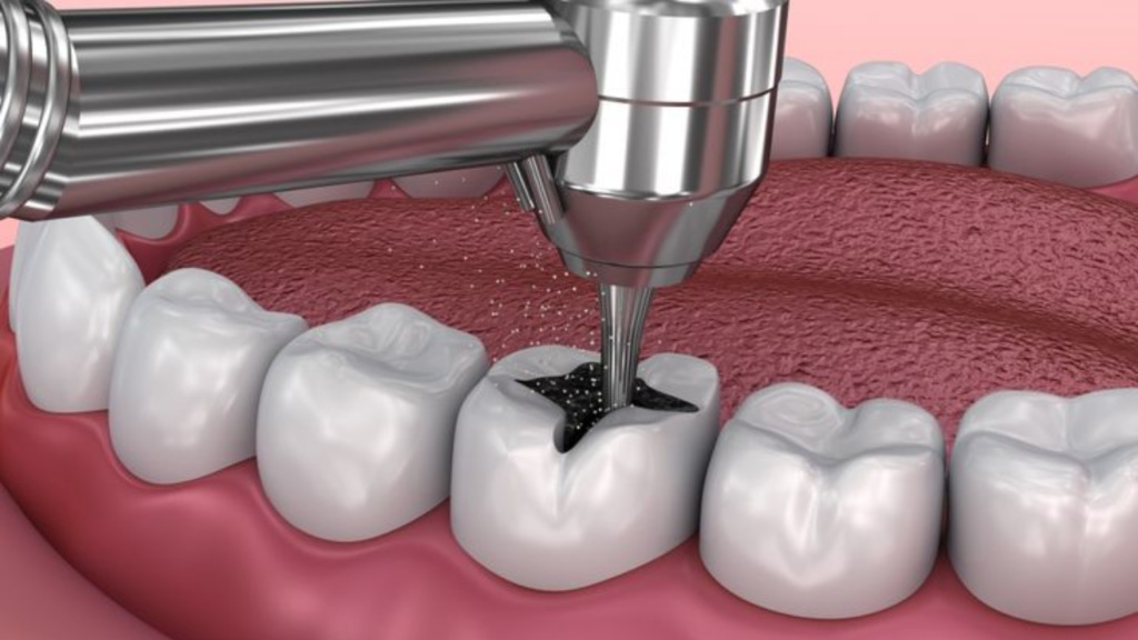 อุดฟันสีเหมือนฟันอยู่ได้กี่ปี