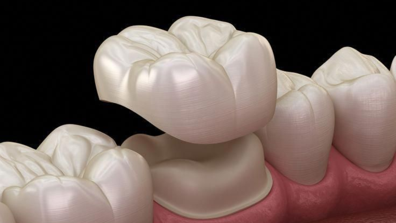 ครอบฟันเหมาะกับใครบ้าง