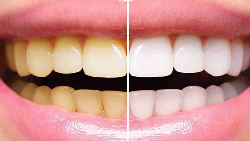 ฟอกสีฟันอยู่ได้นานไหม ควรทำบ่อยแค่ไหน