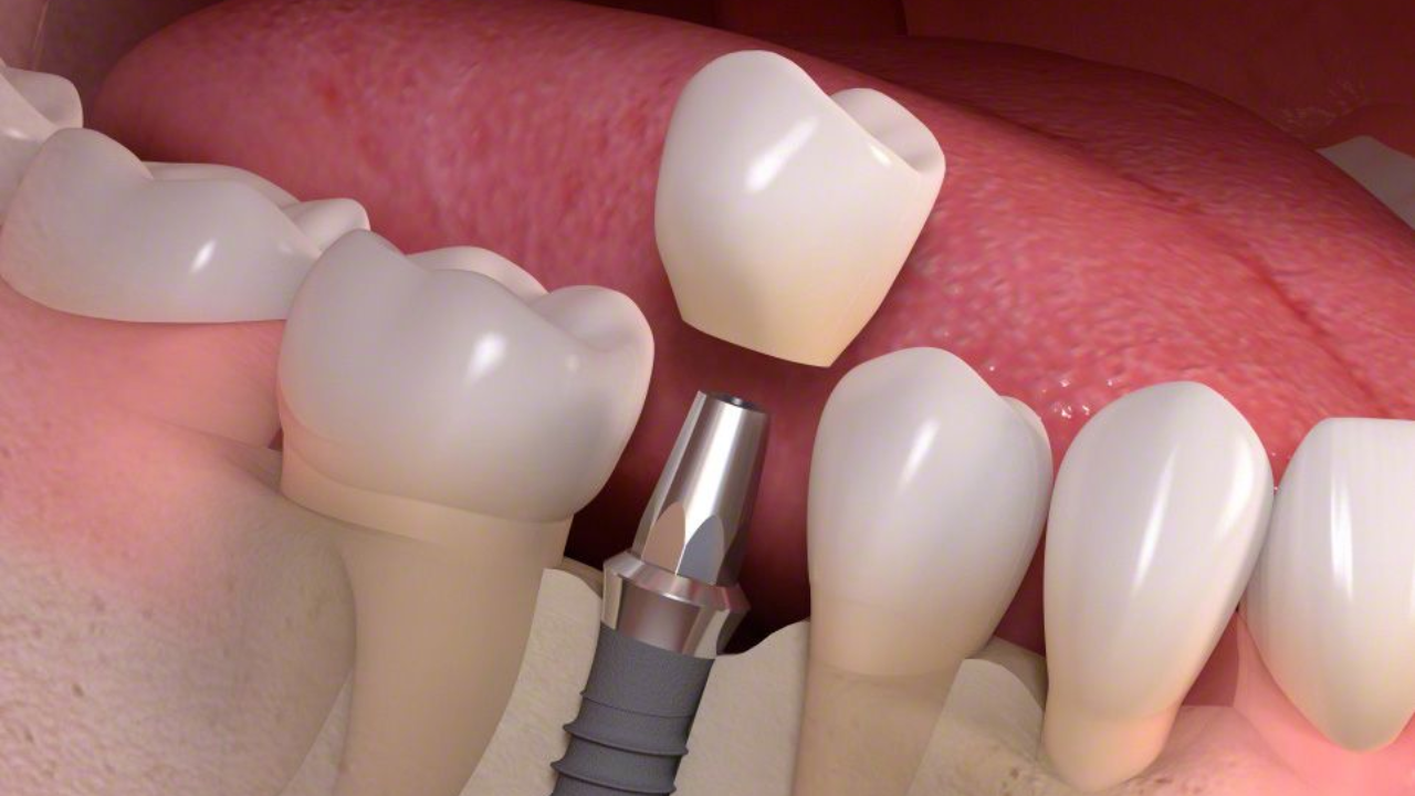 รากฟันเทียมอยู่ได้นานแค่ไหน