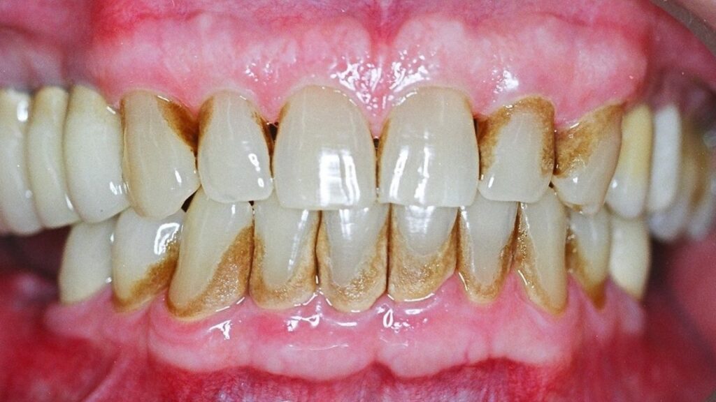 คราบหินปูนเกิดจากอะไร