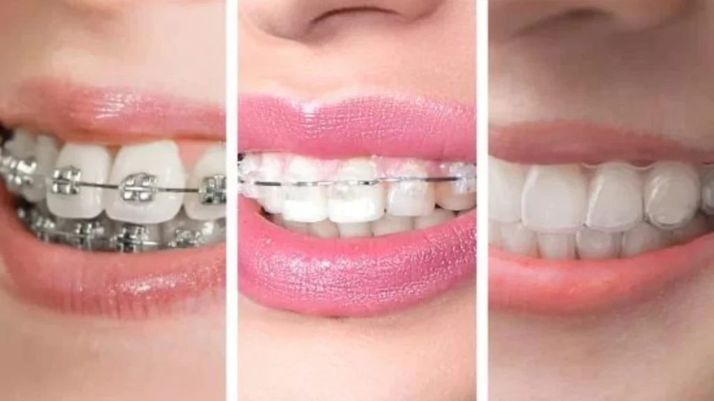 จัดฟันมีกี่แบบ