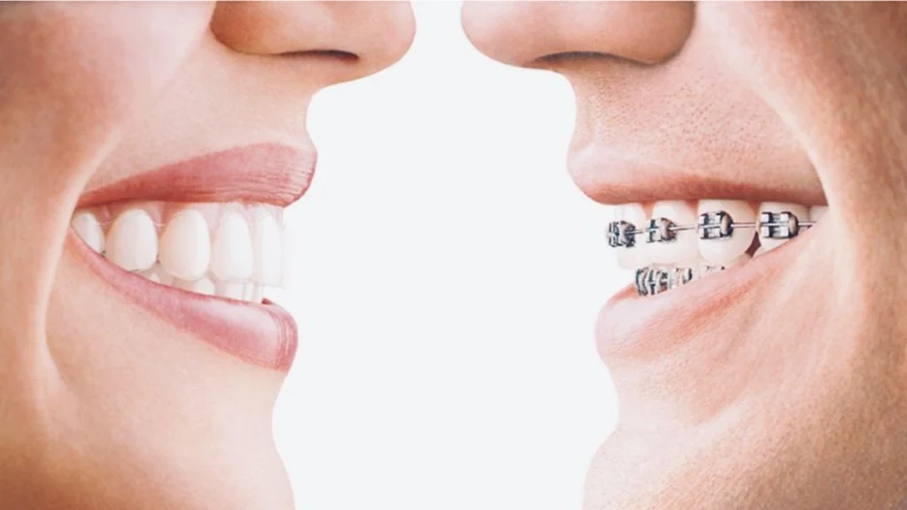 จัดฟันใช้เวลานานกี่ปี