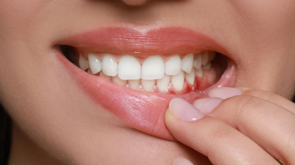 วิธีป้องกันโรคเหงือกอักเสบ